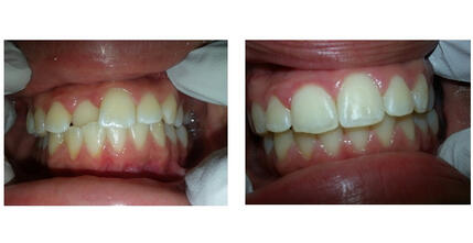 Crossbite Before-After