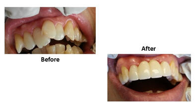 Upper Front Teeth Crowns Before-After
