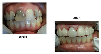Upper Front Teeth Crowns Before-After