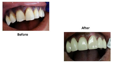 Upper front teeth Veneers Before-After