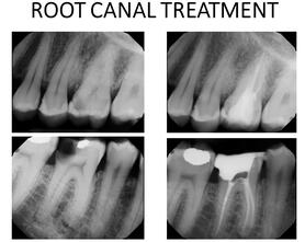 Root Canal Treatment Before-After