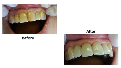 Upper Front Teeth Crowns Before-After